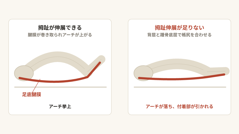 足の側面図2枚の比較。拇趾が伸展できる側は足底腱膜が巻き取られて内側縦アーチが上がり、拇趾伸展が足りない側はアーチが落ちて踵骨の付着部が引かれる