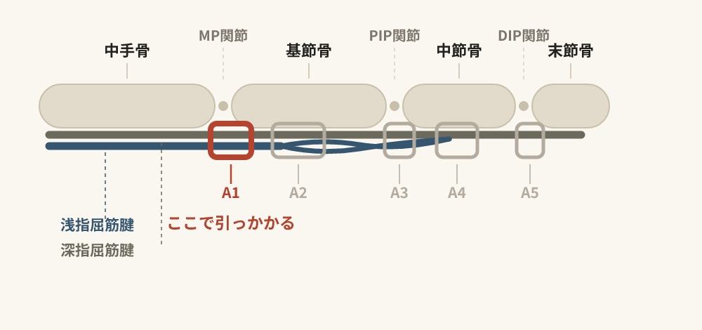 指の側面図。中手骨から末節骨までの骨と、浅指屈筋腱・深指屈筋腱、A1からA5の輪状滑車の位置。MP関節部のA1プーリーを強調している