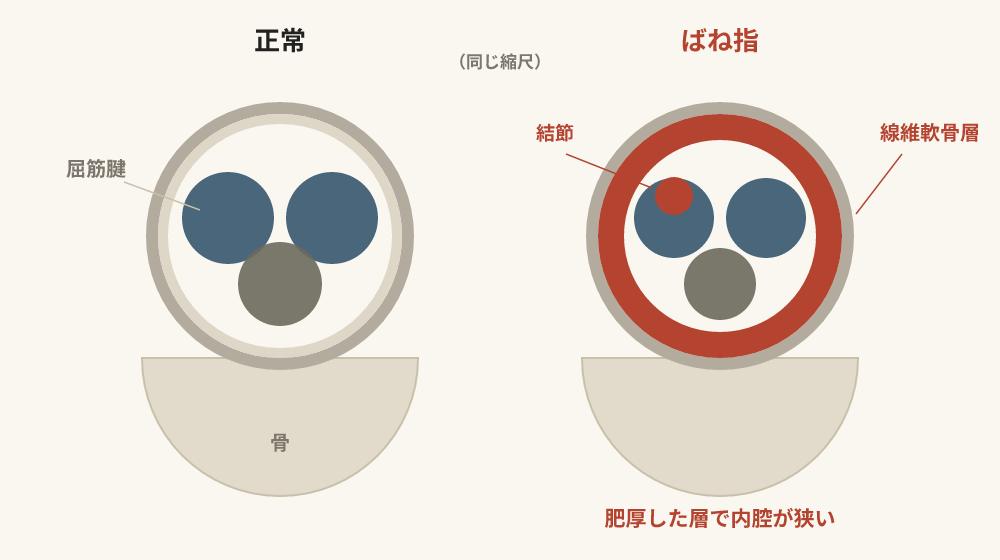 A1プーリーの横断面の模式図。正常では内側の線維軟骨層が薄いが、ばね指では肥厚して内腔が狭くなり、腱に結節が生じている
